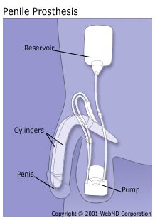 penileprosthesis