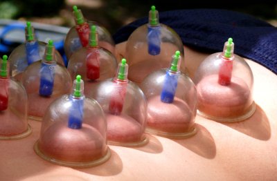 cupping